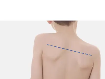 척추 측만